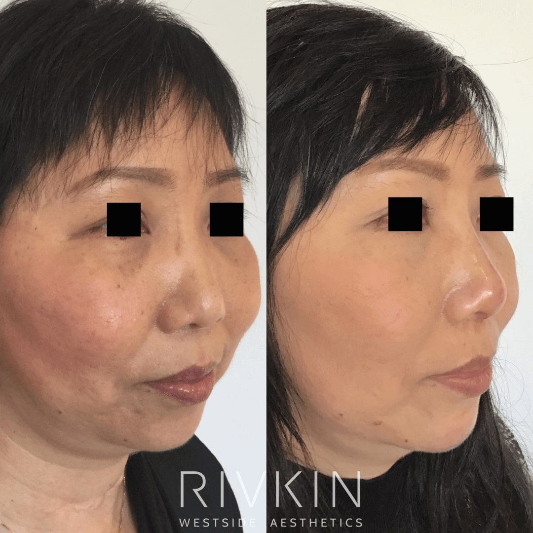 Before and After - Asian Nose