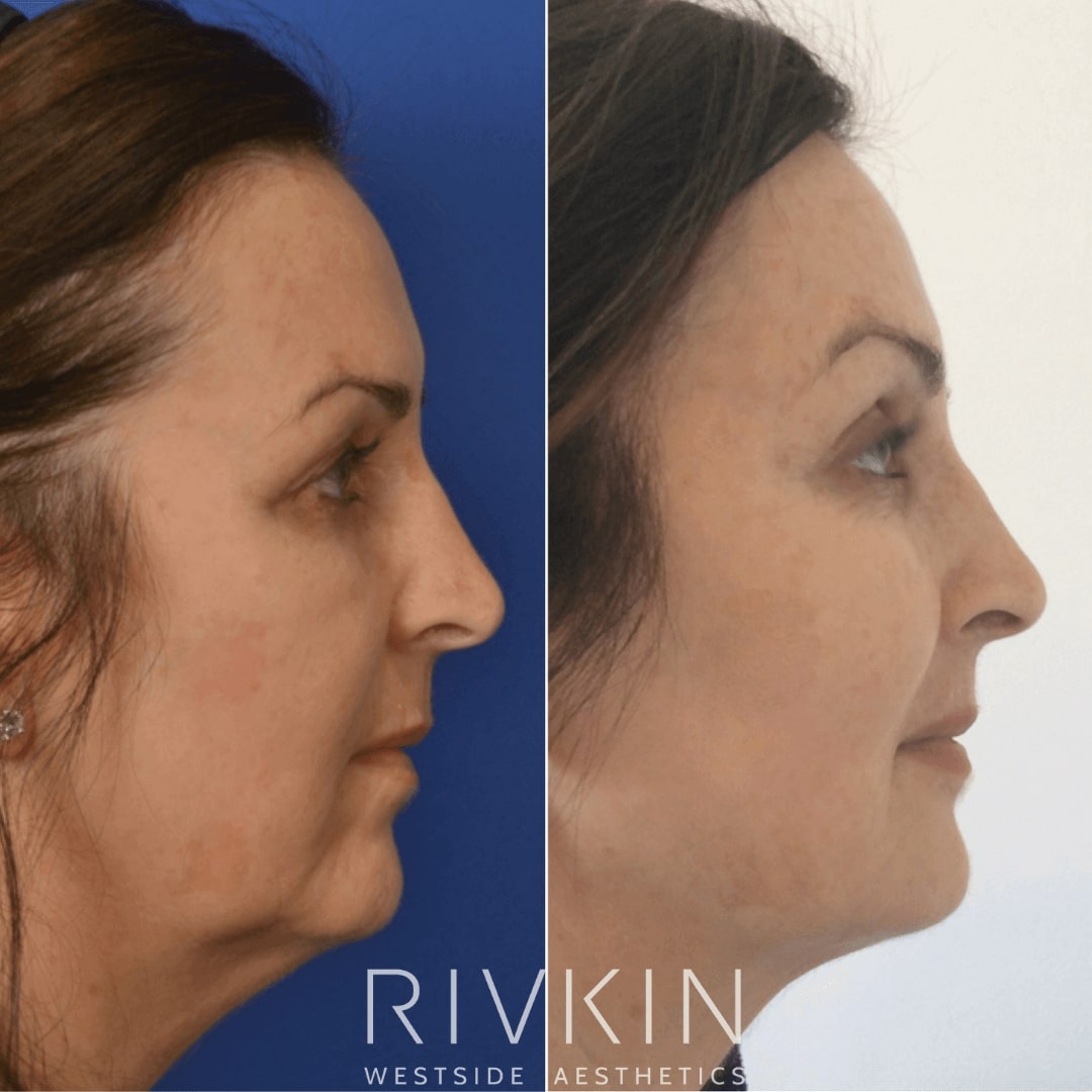 Before and After - Kybella