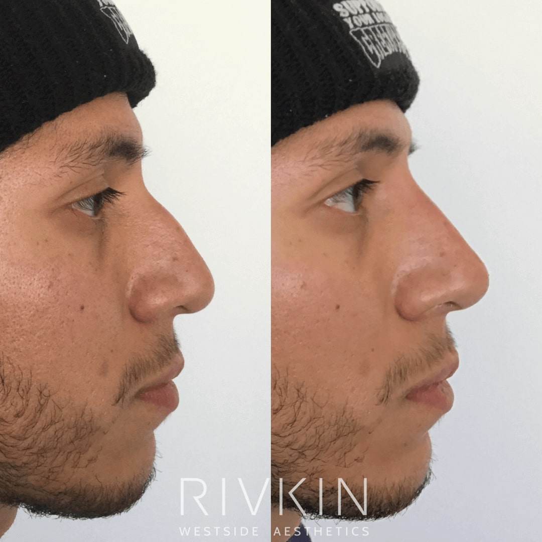 Before and After - Hispanic Nose