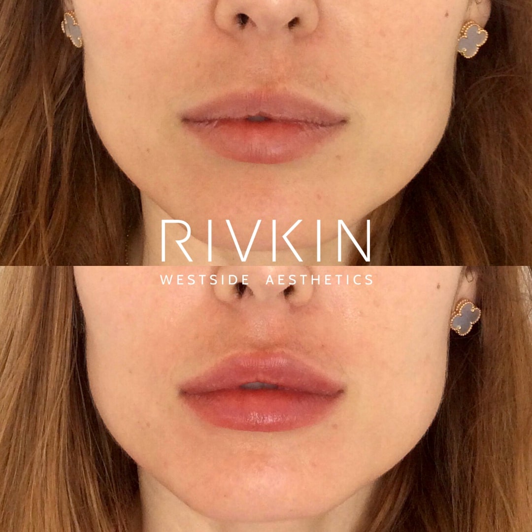 Before and After - Lips