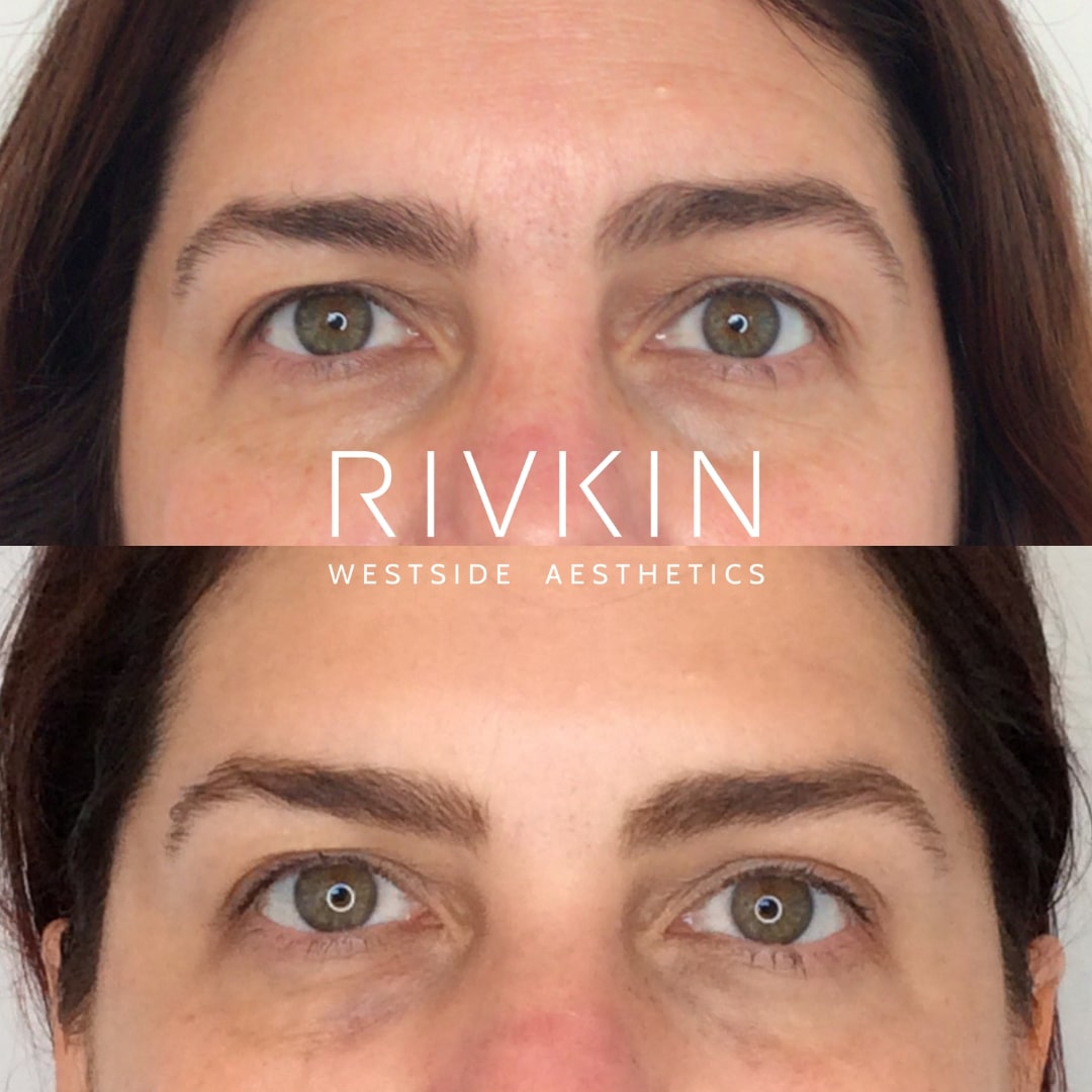 Before and After - Botox/Botox brow lift