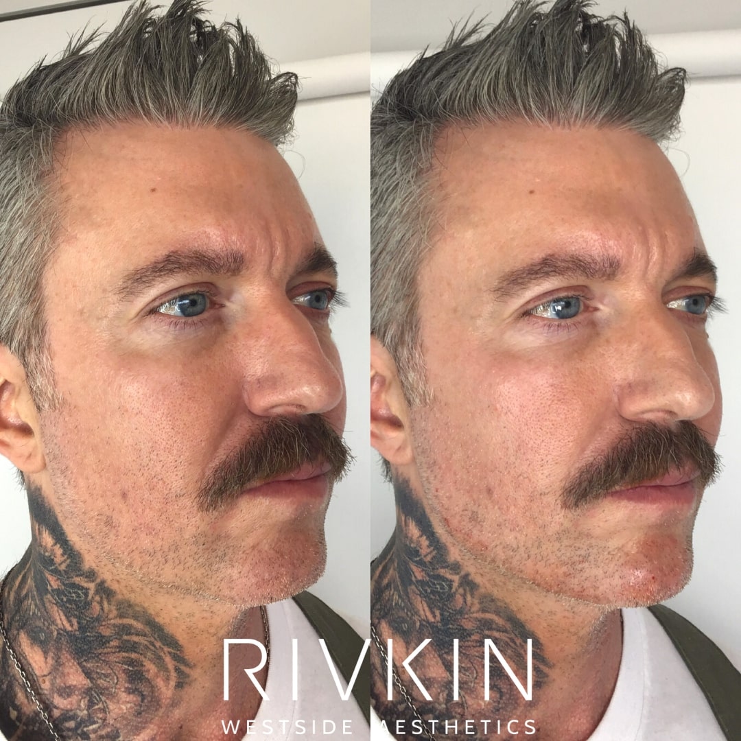 Before and After - Chin