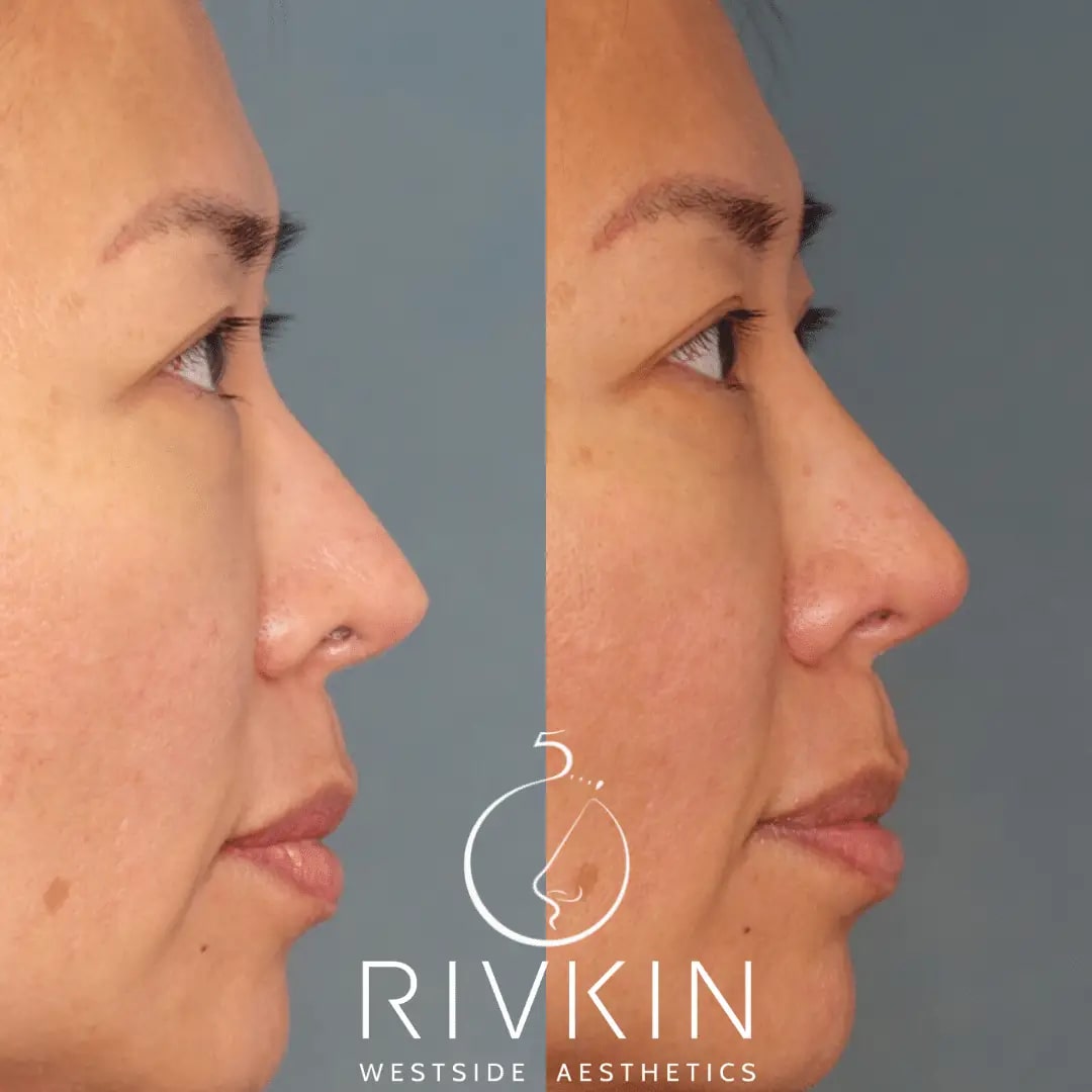 Before and After - Revision Rhinoplasty