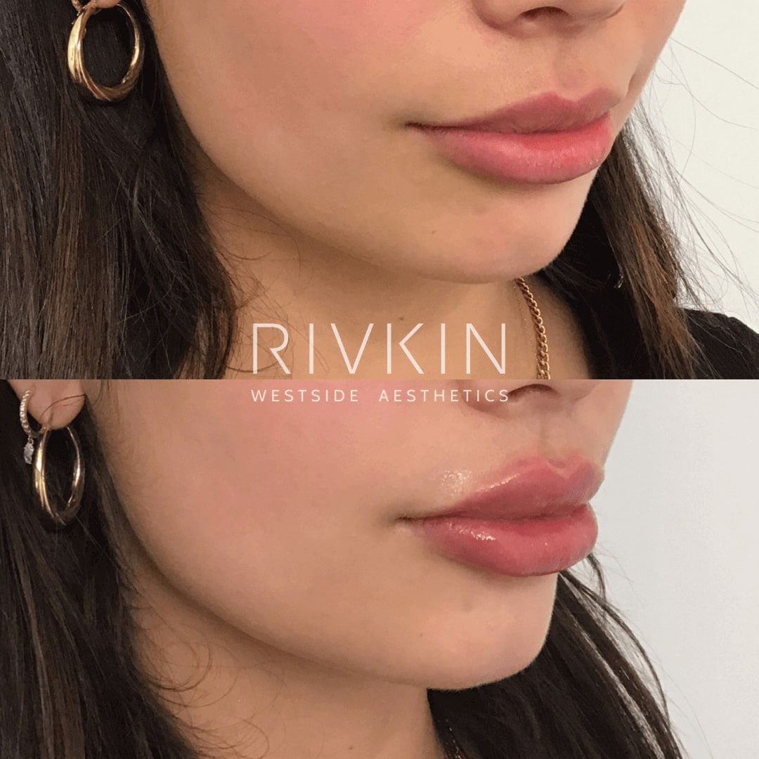 Before and After - Lips