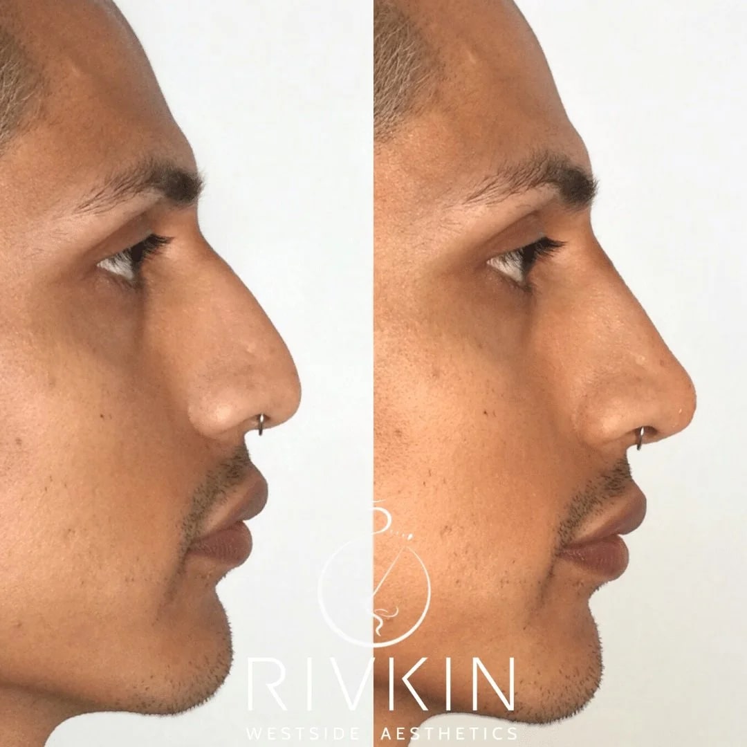 Before and After - Hispanic Nose