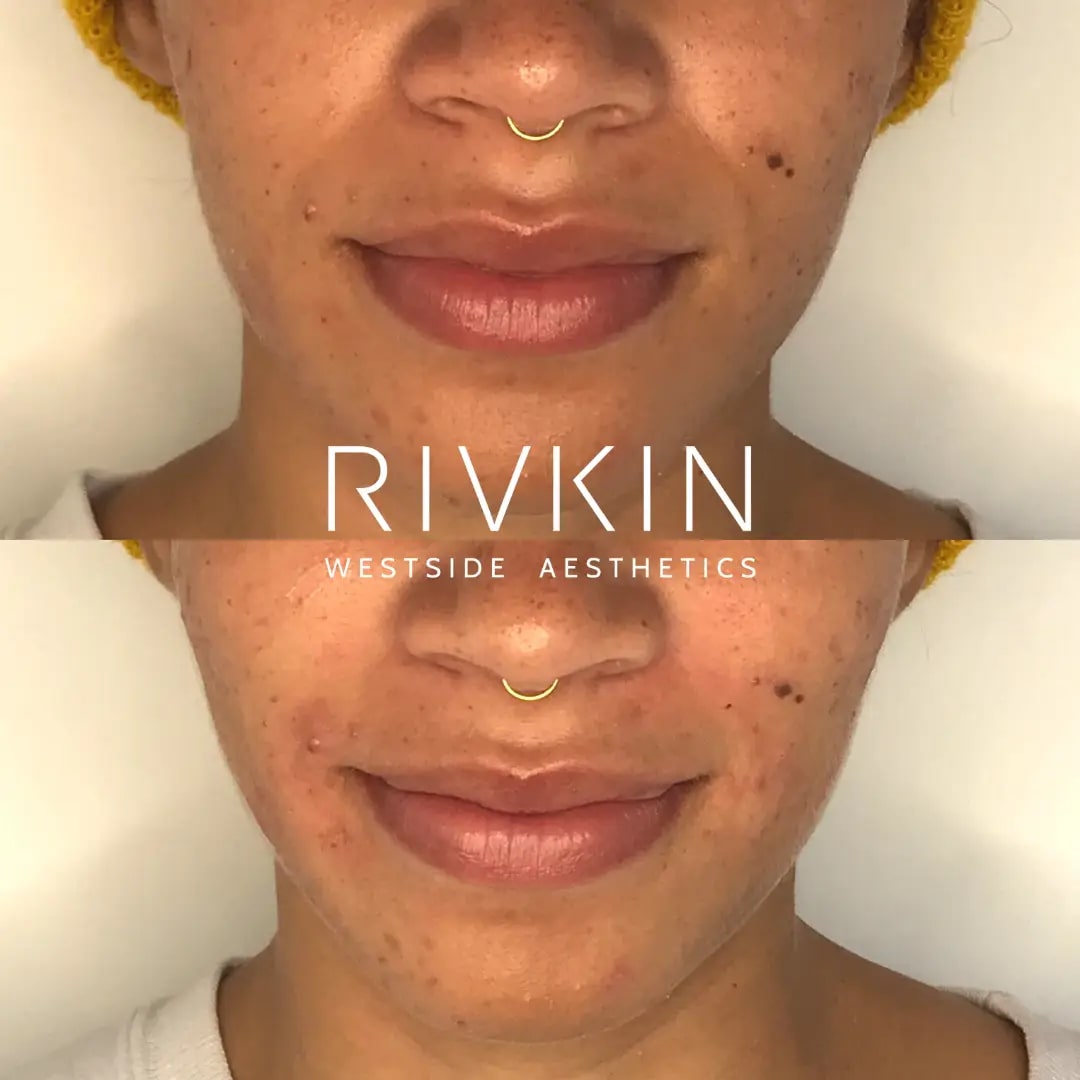 Before and After - Restylane