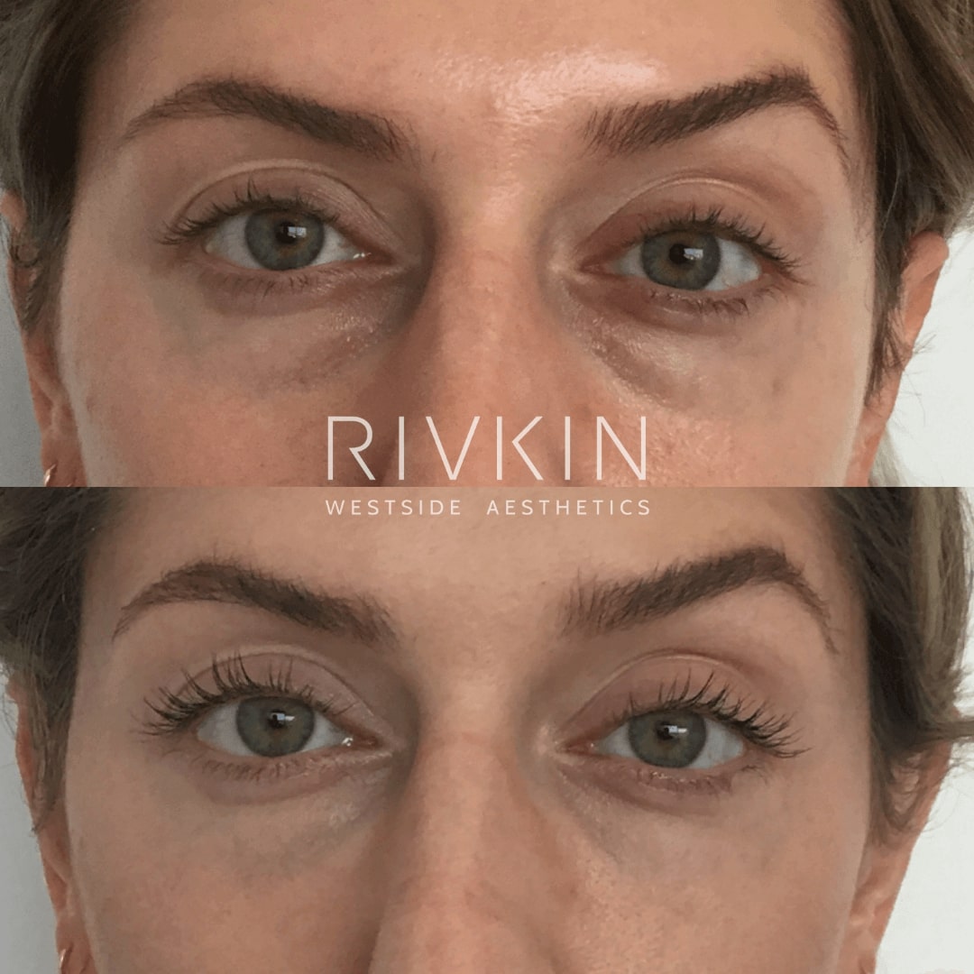 Before and After - Blepharoplasty