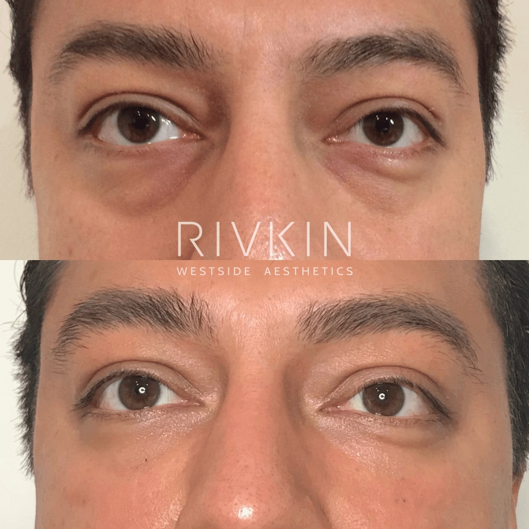 Before and After - Blepharoplasty