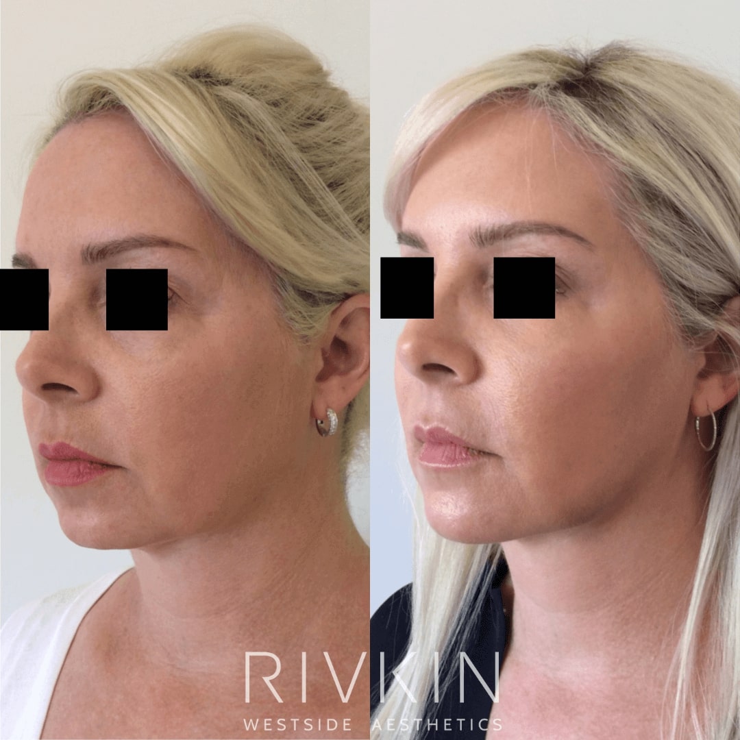 Before and After - Non Surgical Facelift