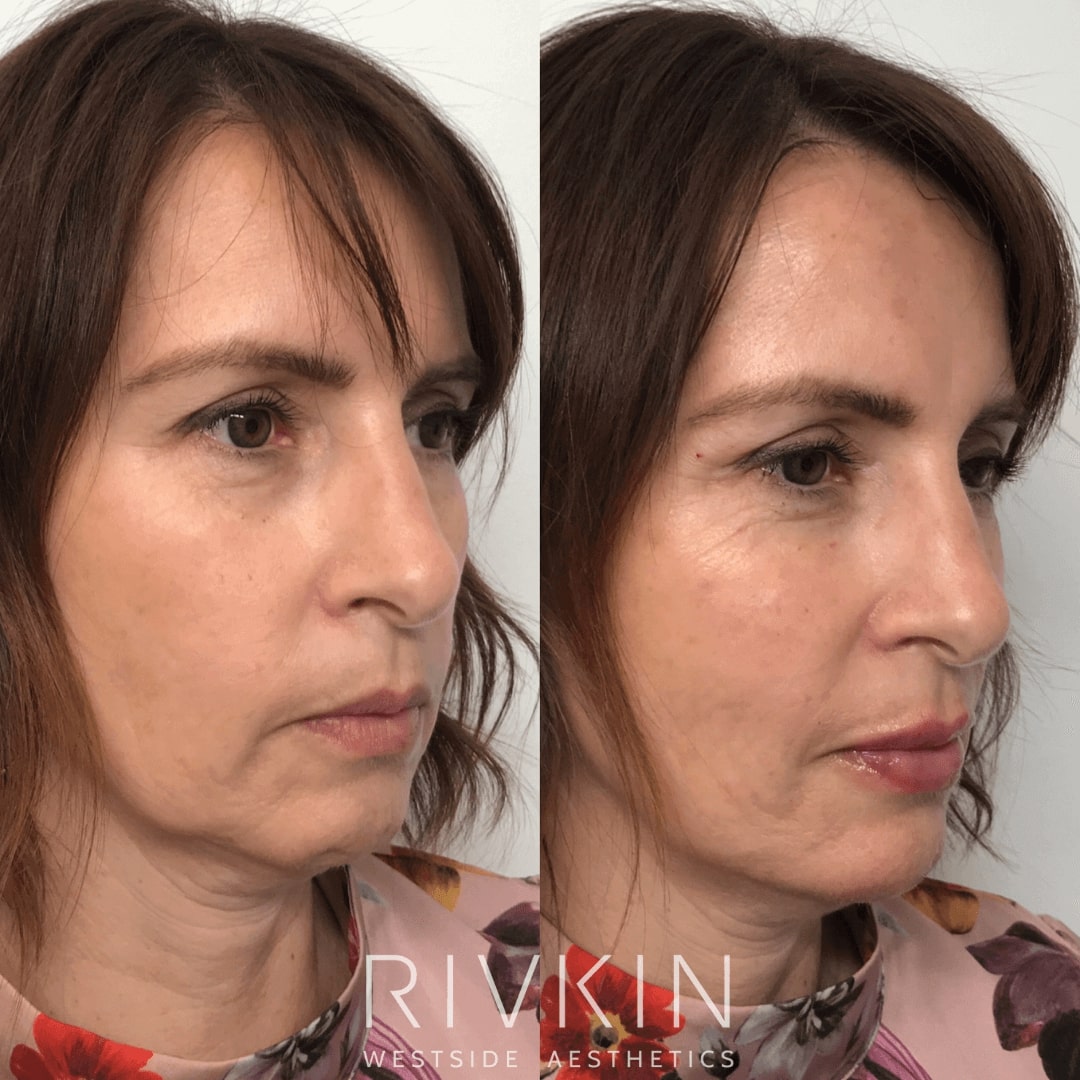 Before and After - Non Surgical Facelift