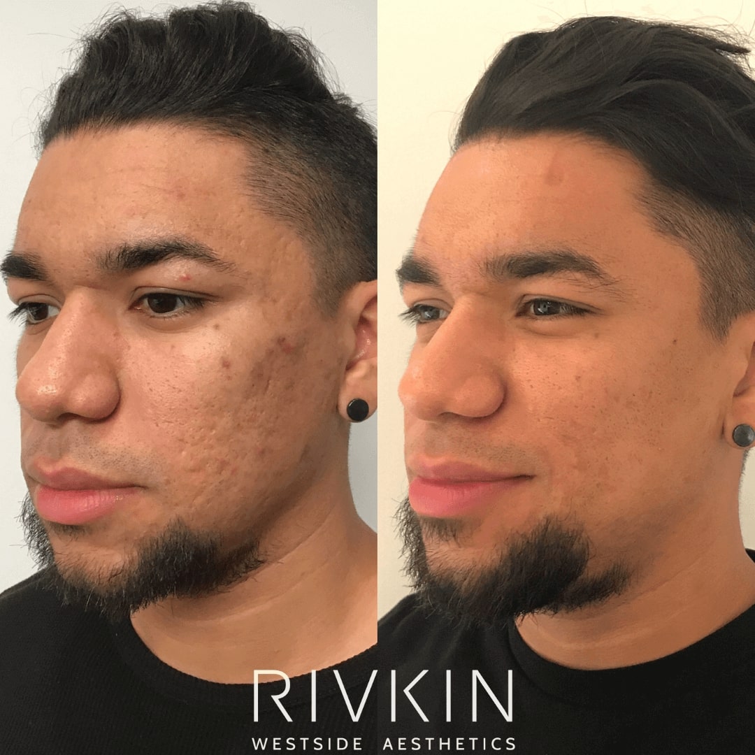 Before and After - PRP (Platelet Rich Plasma)