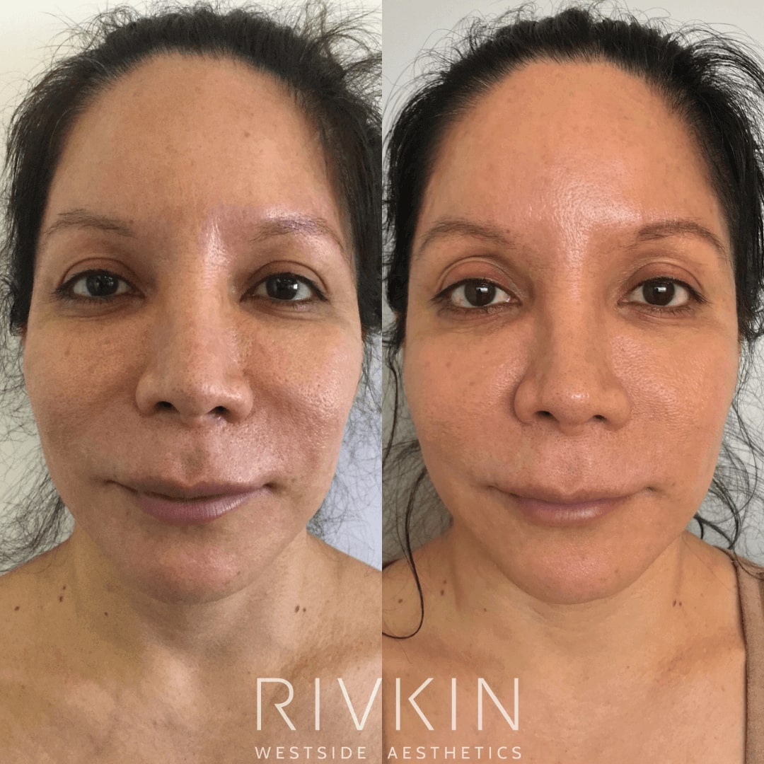 Before and After - PRP (Platelet Rich Plasma)