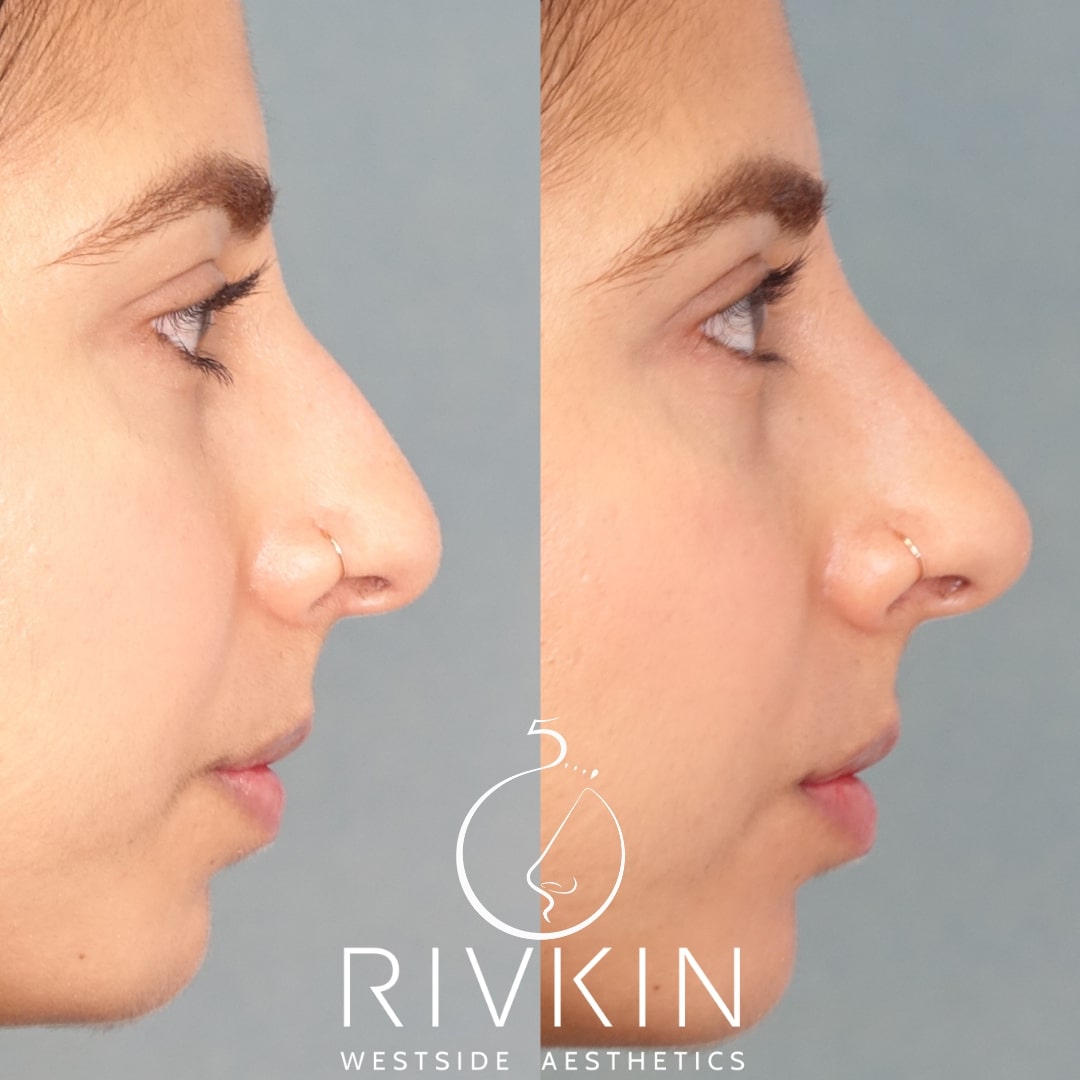 Before and After - Middle Eastern Nose