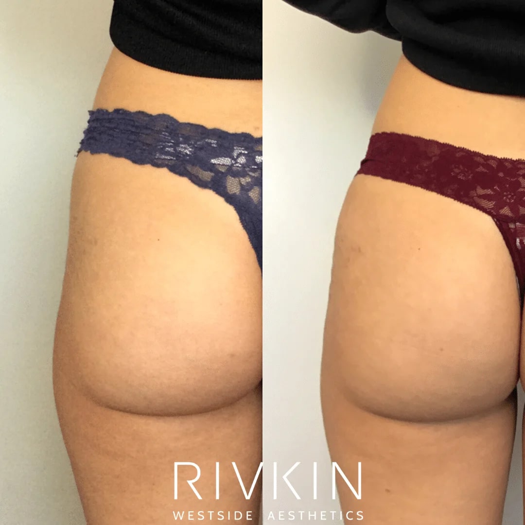 Before and After - Sculptra Butt