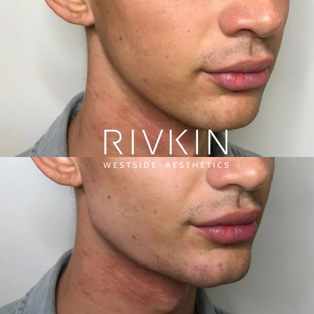 Before and After - Jawline