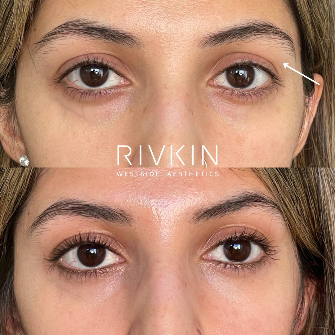Before and After - Botox/Botox brow lift