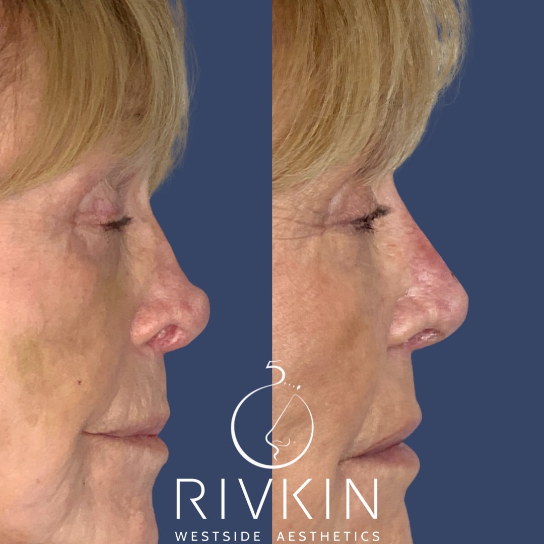 Before and After - Revision Rhinoplasty