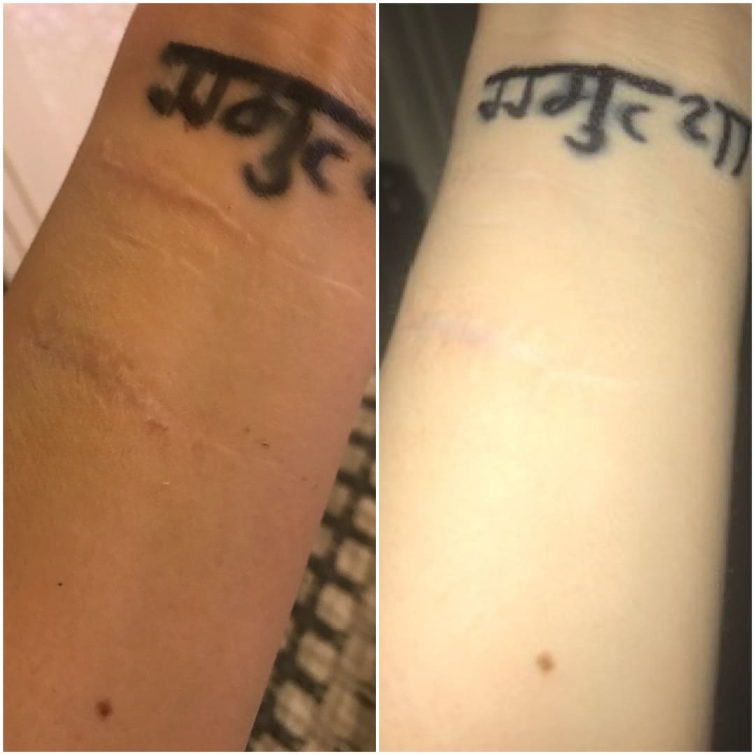 Before and After - Self-Harm Scar