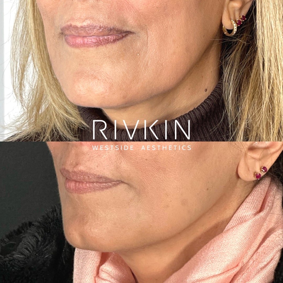 Before and After - Kybella