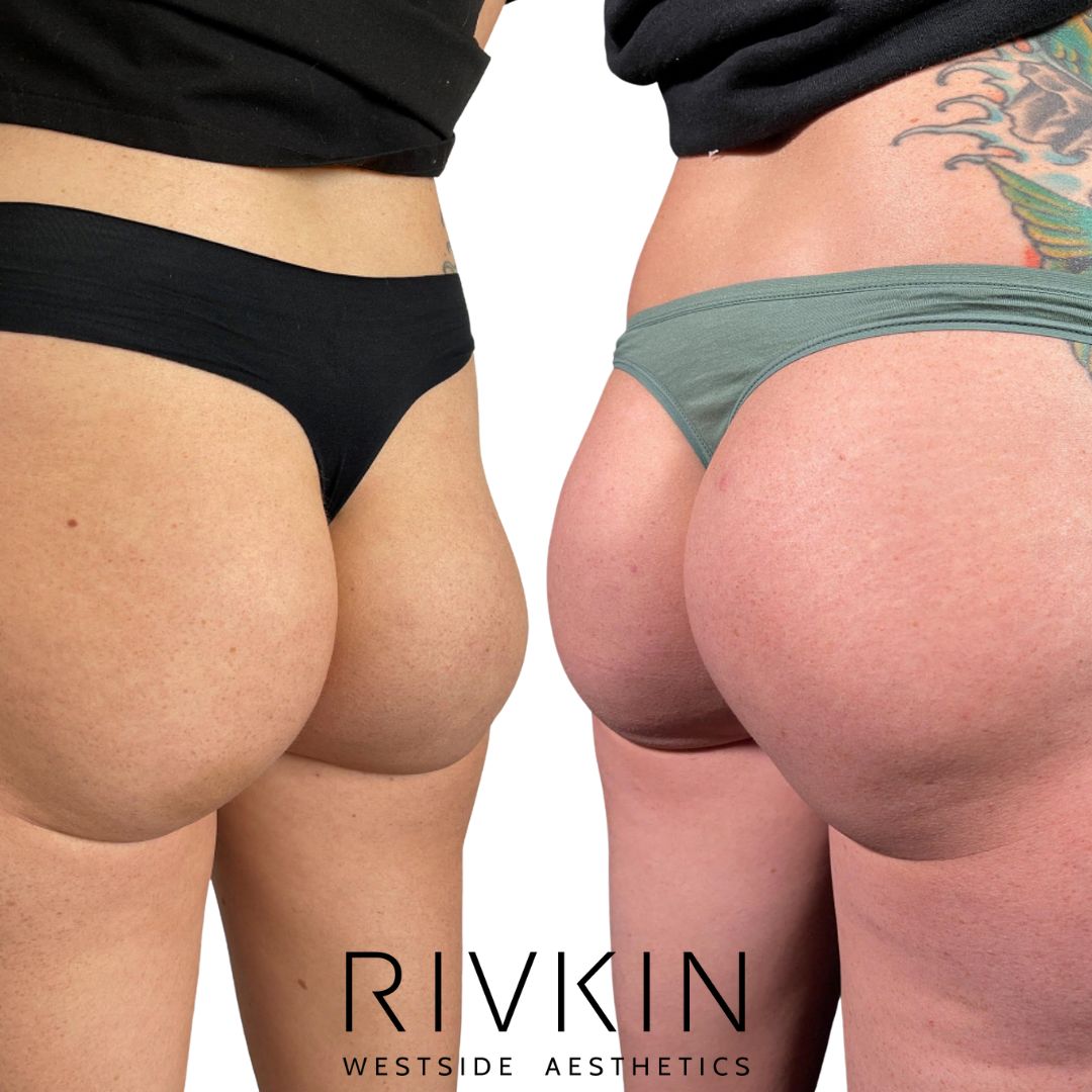 Before and After - Radiesse Butt