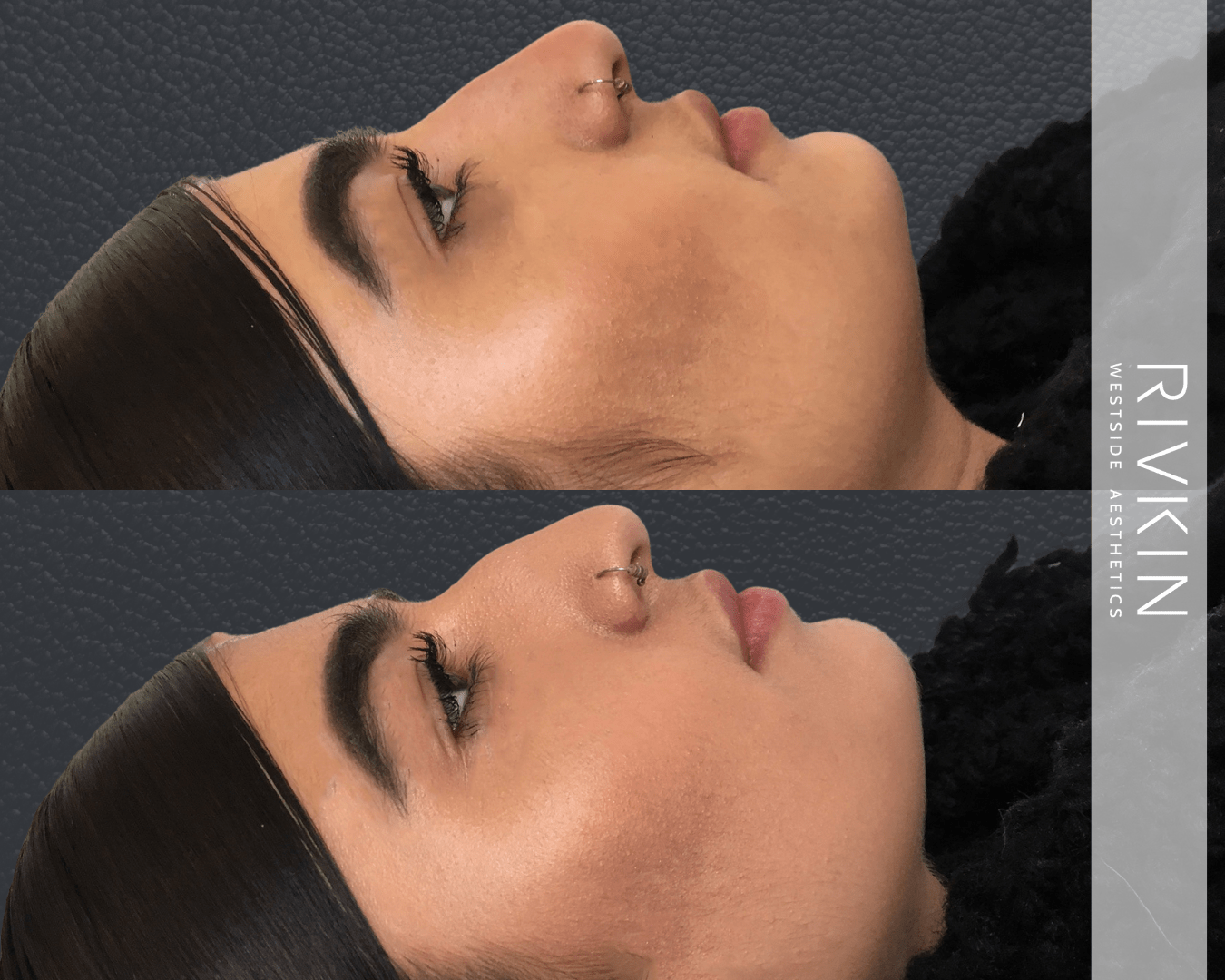 Before and After - Middle Eastern Nose