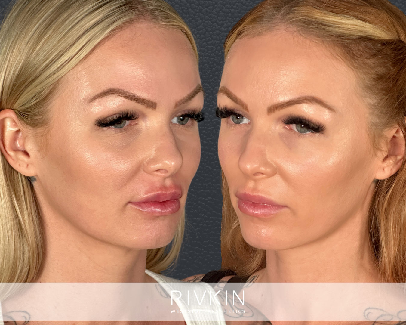 before and after photos following non-surgical blapharoplasty