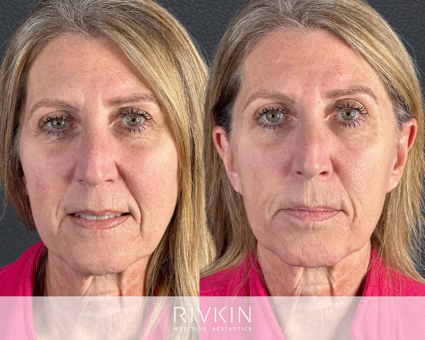 Before and After - Nasolabial Folds