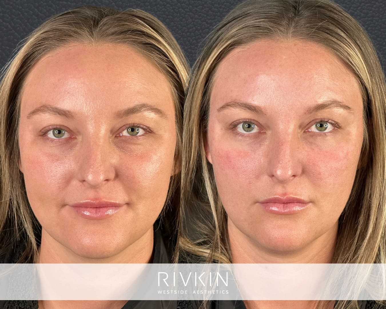 Before and After - Undereye Filler Injection