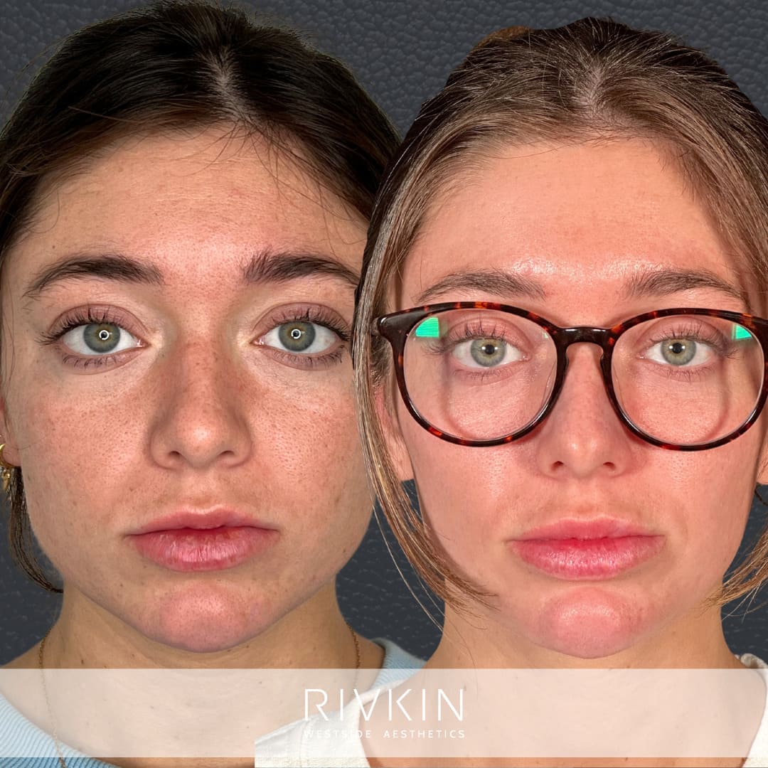 Before and After - Sylfirm X RF Microneedling