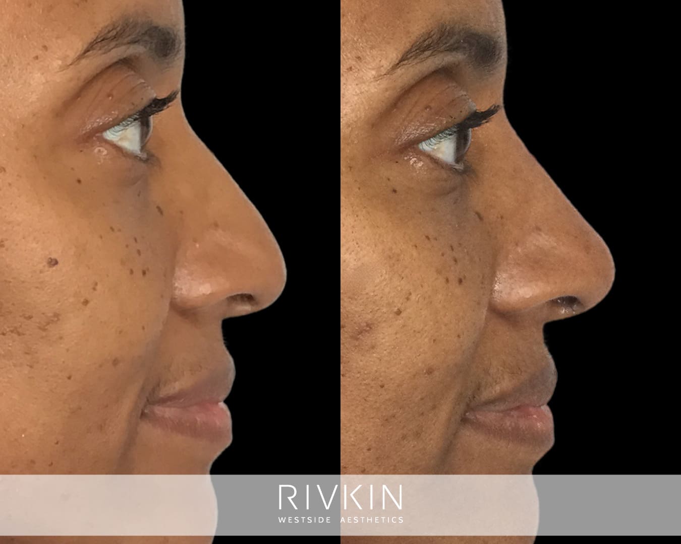 Before and After - African American Nose