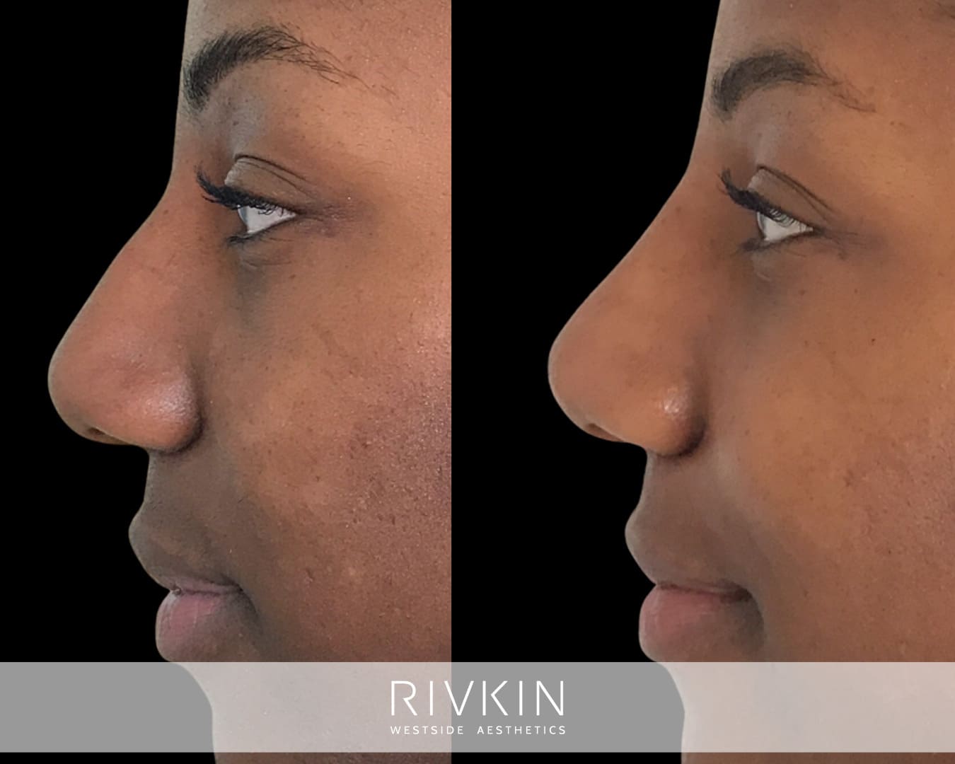 Before and After - African American Nose