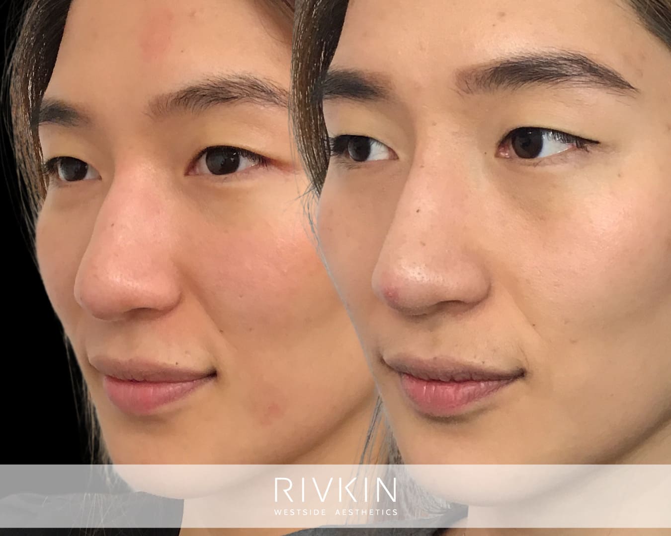 Before and After - Asian Nose