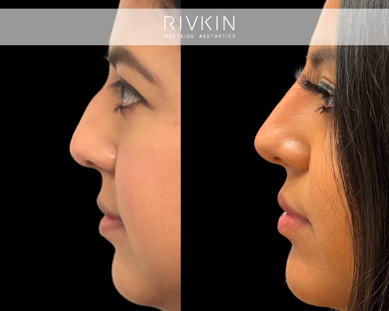 This patient's profile underwent a successful enhancement through the combination of a non-surgical nose job and chin filler injection. These two procedures are frequently recommended together by experts in the field, and adhering to your provider's recommendations can lead to transformations like this one.