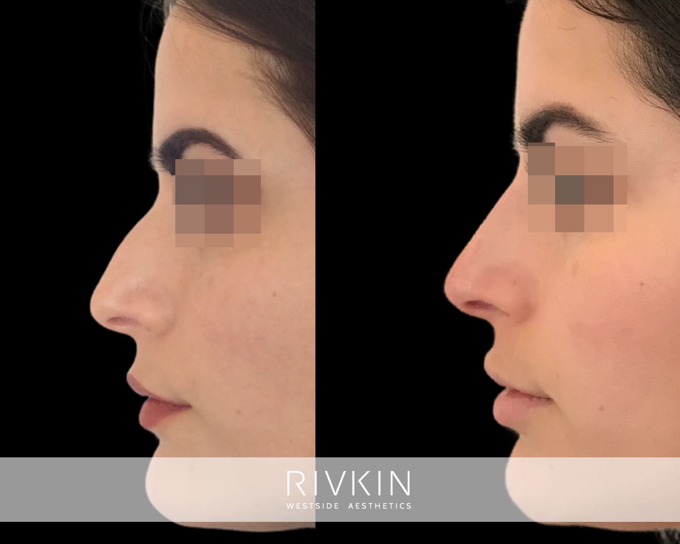 woman before and after bump nose coorection