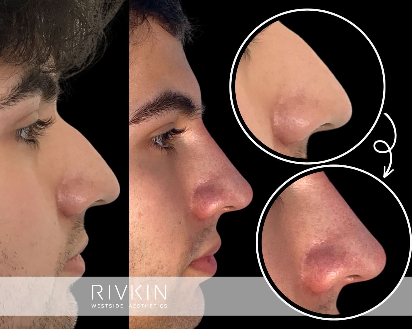 man before and after bump nose coorection procedure