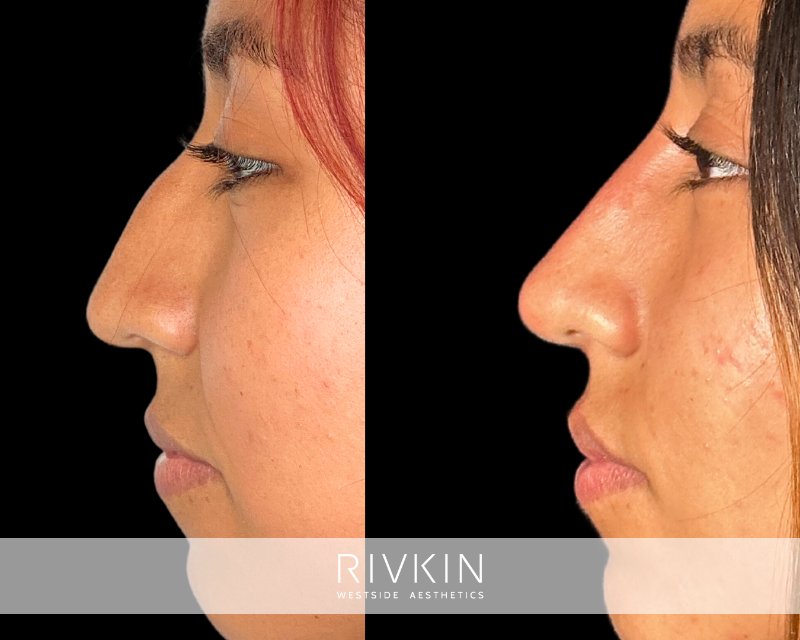 The straight bridge and uplifted tip achieved through liquid rhinoplasty have completely transformed this patient's face.