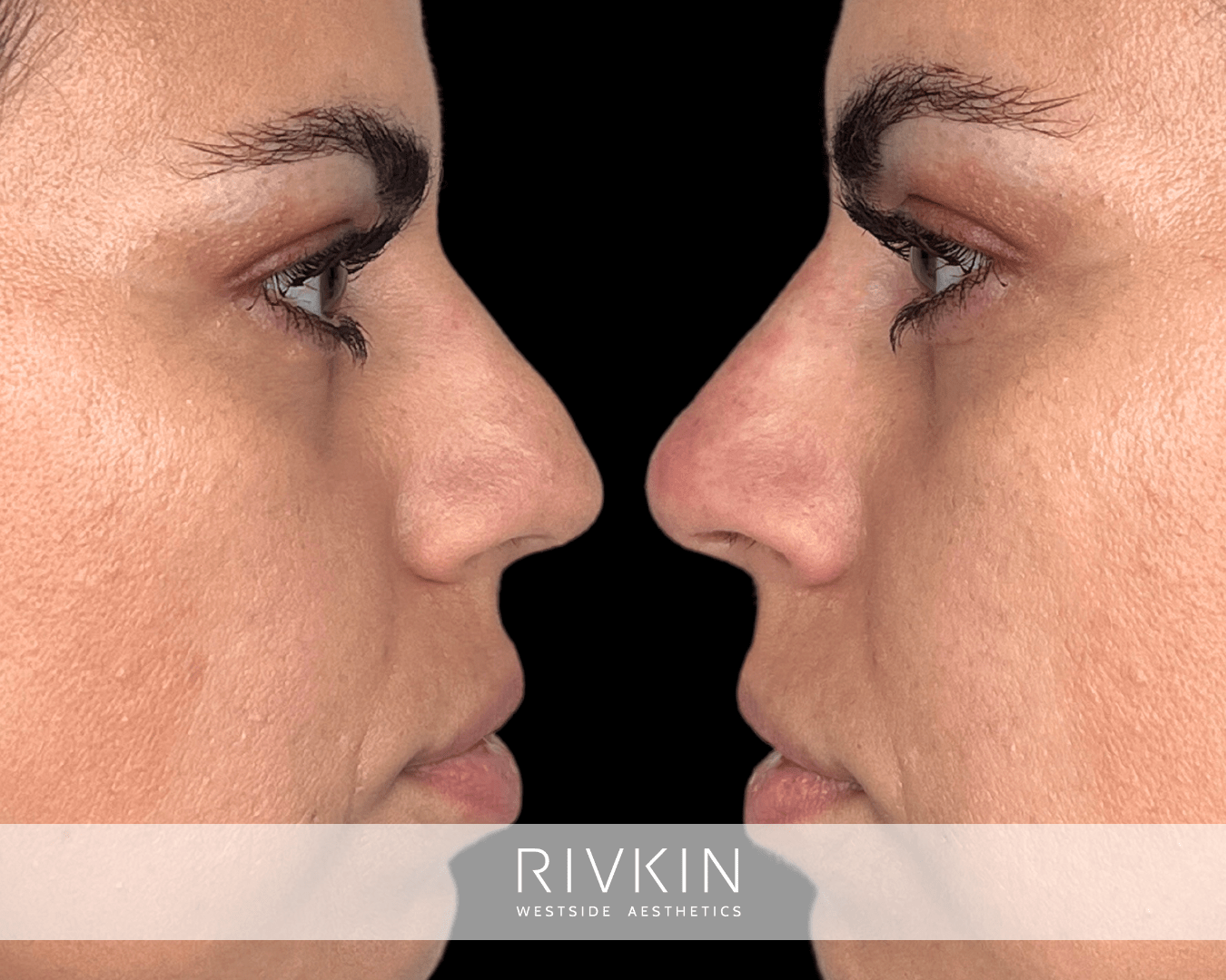 This patient's face looks very different after nurse practitioner Presile performed a liquid rhinoplasty to correct the droopiness of her nose and smooth the contours.