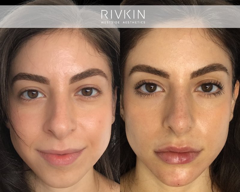 This patient underwent a complete facial makeover, which included a non-surgical nose job, chin augmentation, and lip filler treatment. The results of these procedures are both noticeable and natural, enhancing the patient's facial features while maintaining harmony and balance.