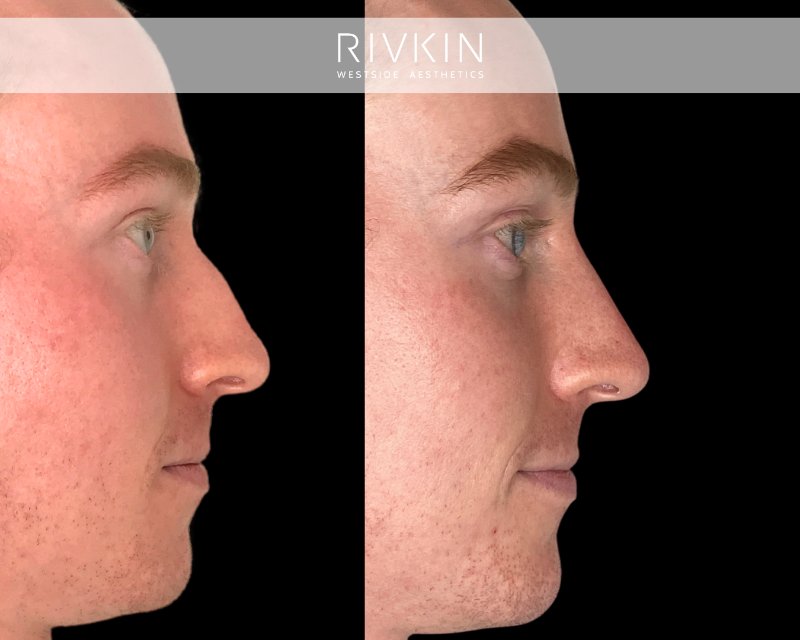 This patient underwent the non-surgical nose job to get rid of the bump on his nose. To make his profile even more balanced, Dr. Rivkin made his chin a little bit more projected by injecting some dermal filler.