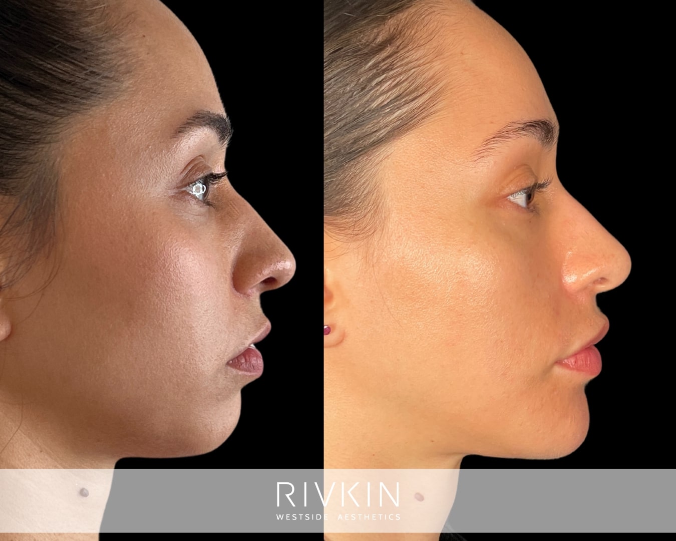 This patient got chin filler injection, liquid rhinoplasty and a little bit of lip filler. All these treatments together helped create a well-balanced, harmonious profile.