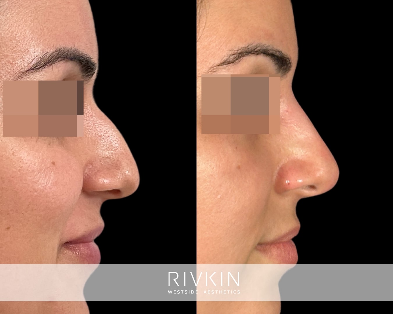 This patient's profile is harmonious and balanced now thanks to nurse practitioner Bahareh who performed her liquid rhinoplasty.