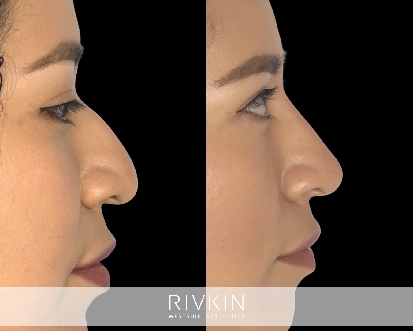 Even extreme droopiness can be corrected with nose filler injections. This patient's tip was successfully uplifted, and the bridge was visibly elevated.