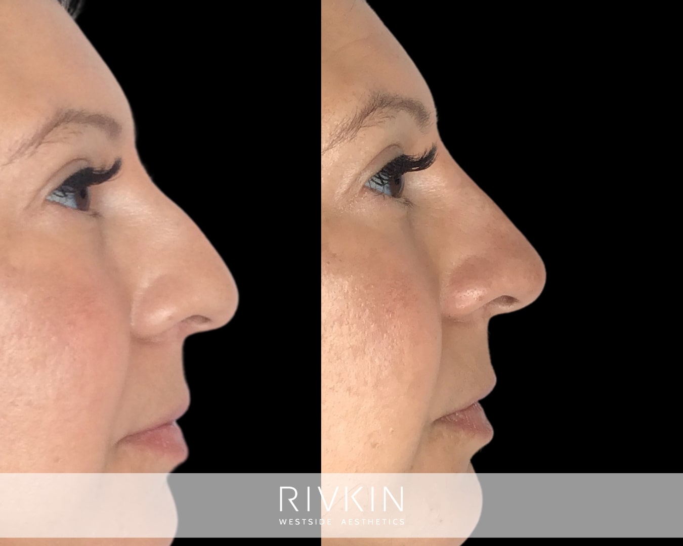 Uplifted and no longer droopy—how do you like her photo right after her liquid rhinoplasty procedure?