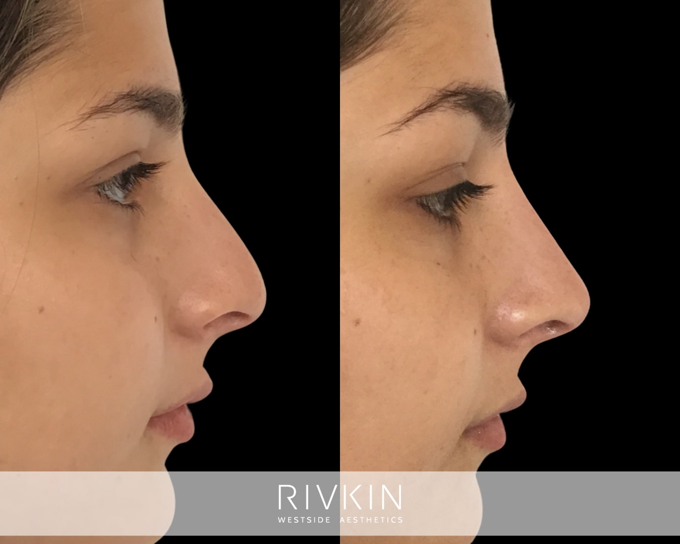 This patient's tip was uplifted for a more harmonious look. The adjustment is very subtle, yet visible and transformative.