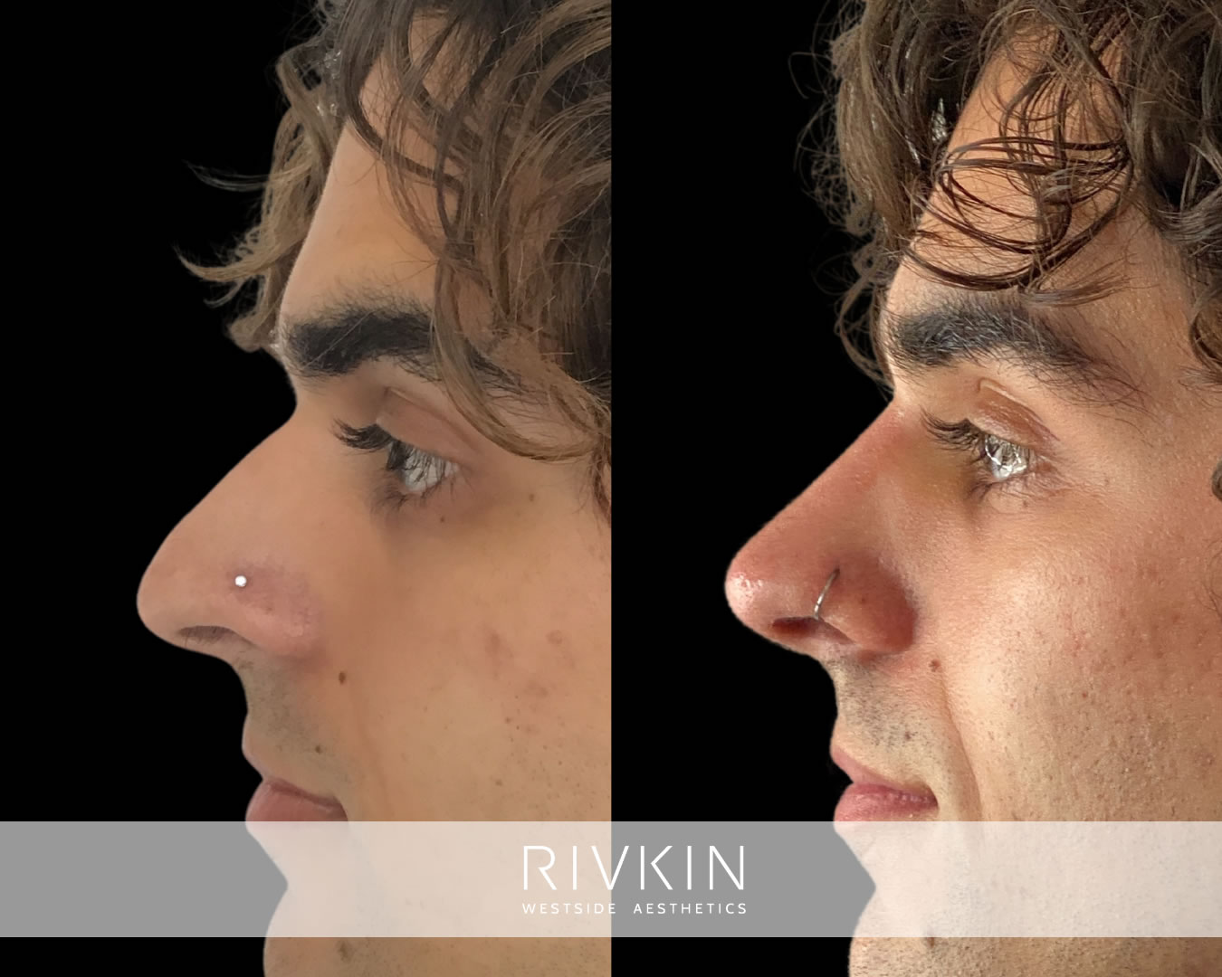 The elevation of this patient's nasal tip has significantly improved overall facial balance.