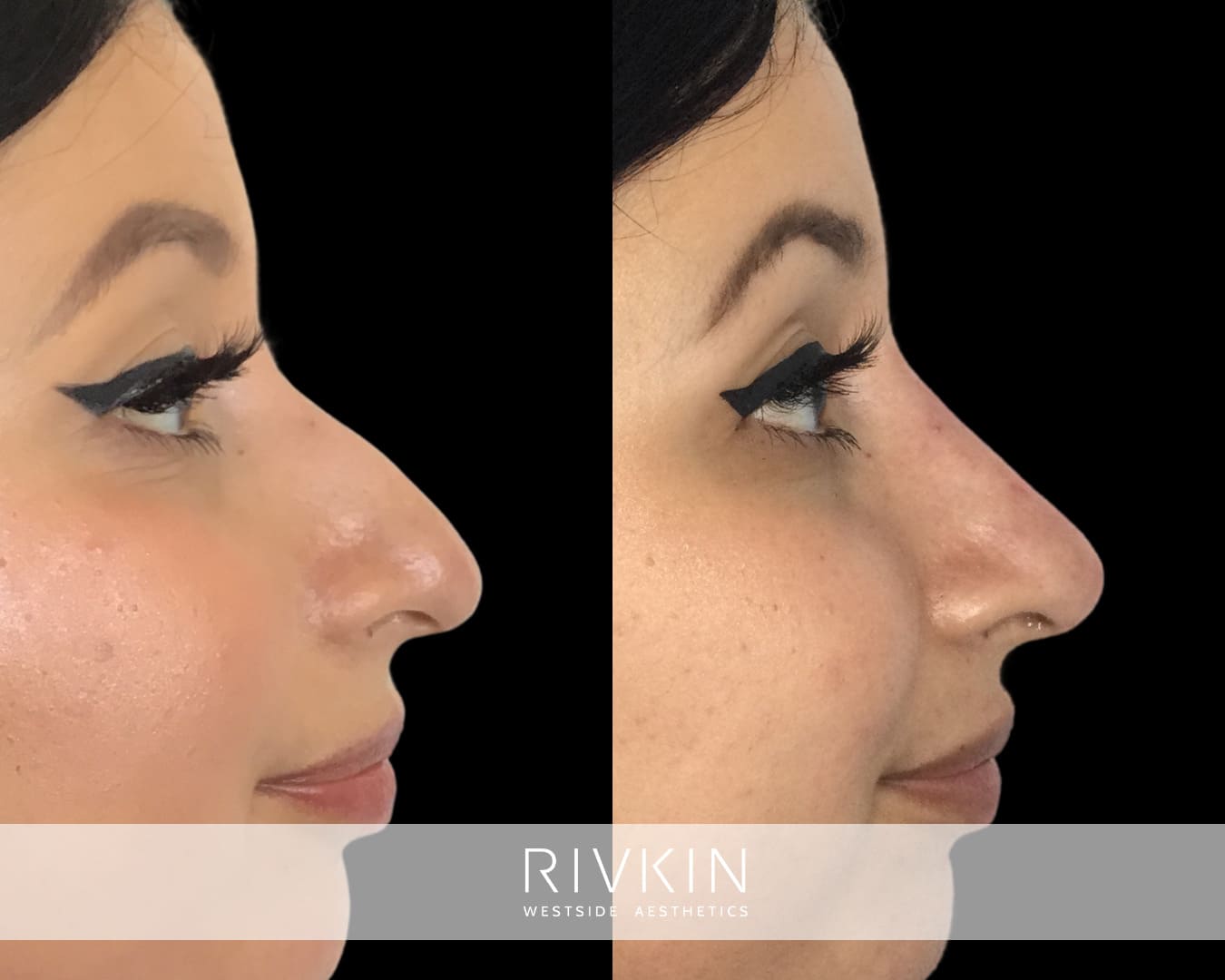 patient before and after droopy tip coorection