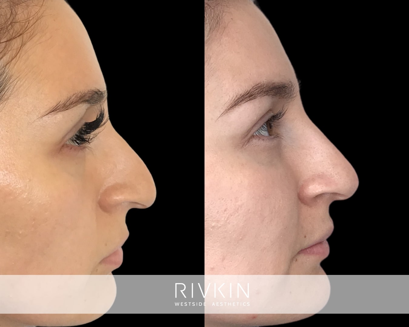 This patient's droopy nasal tip used to accentuate the curvature of their nose, making it appear hooked. Correcting the droopy nasal tip has helped reduce the beaky appearance and improved facial harmony.