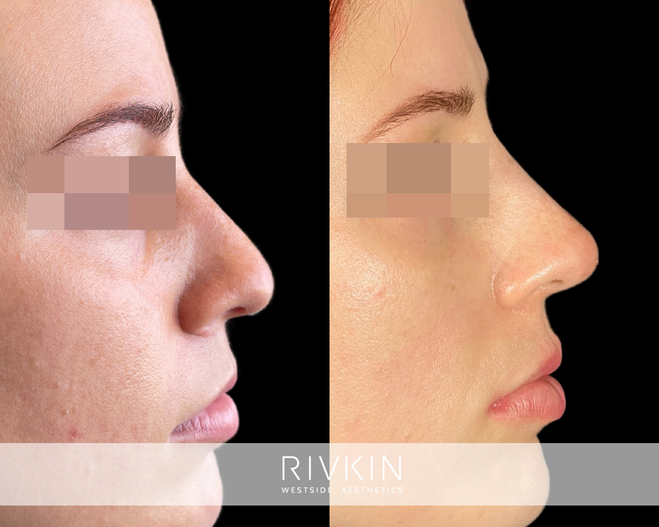 before and after photo of a patient after non-surgical rhinoplasty