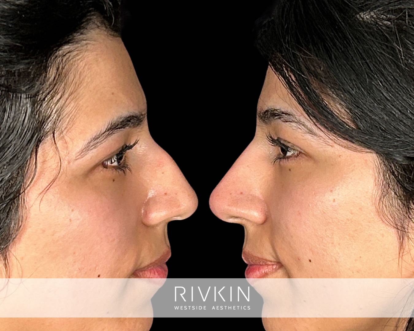 patient before and after smoothing bump on the bridge of her nose