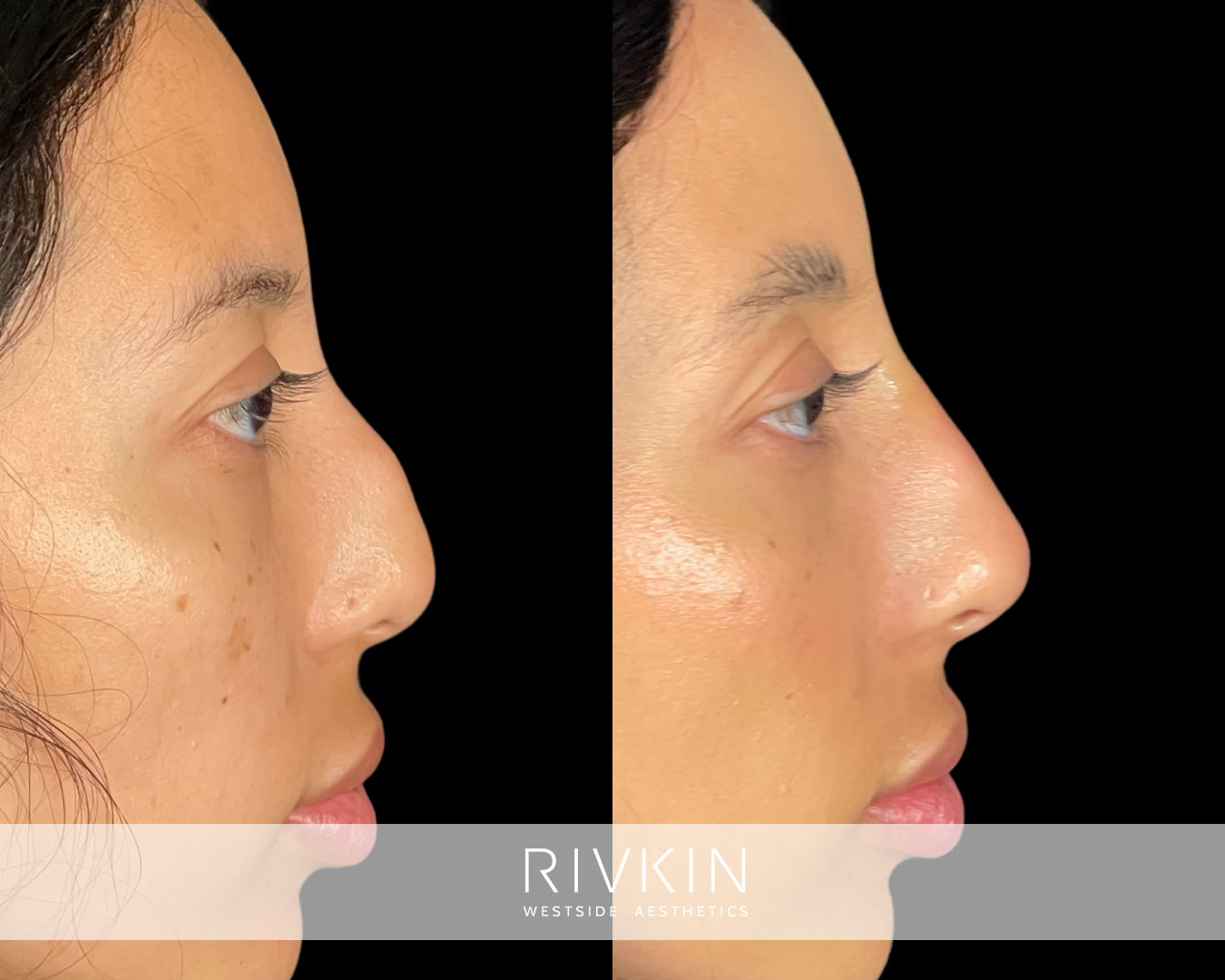 before and after photo of a patient after liquid rhinoplasty